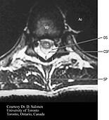 |Healing vertebrae fracture spinous process / healing vertebrae ...